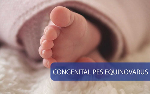 Congenıtal Pes Equınovarus