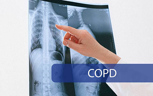 COPD