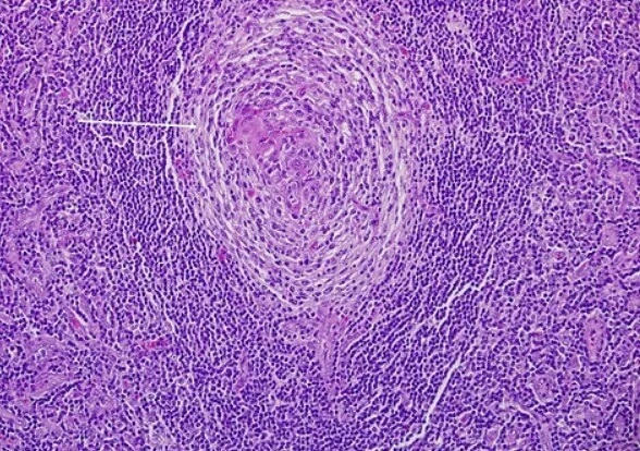 Castleman Hastalığı Nedir?